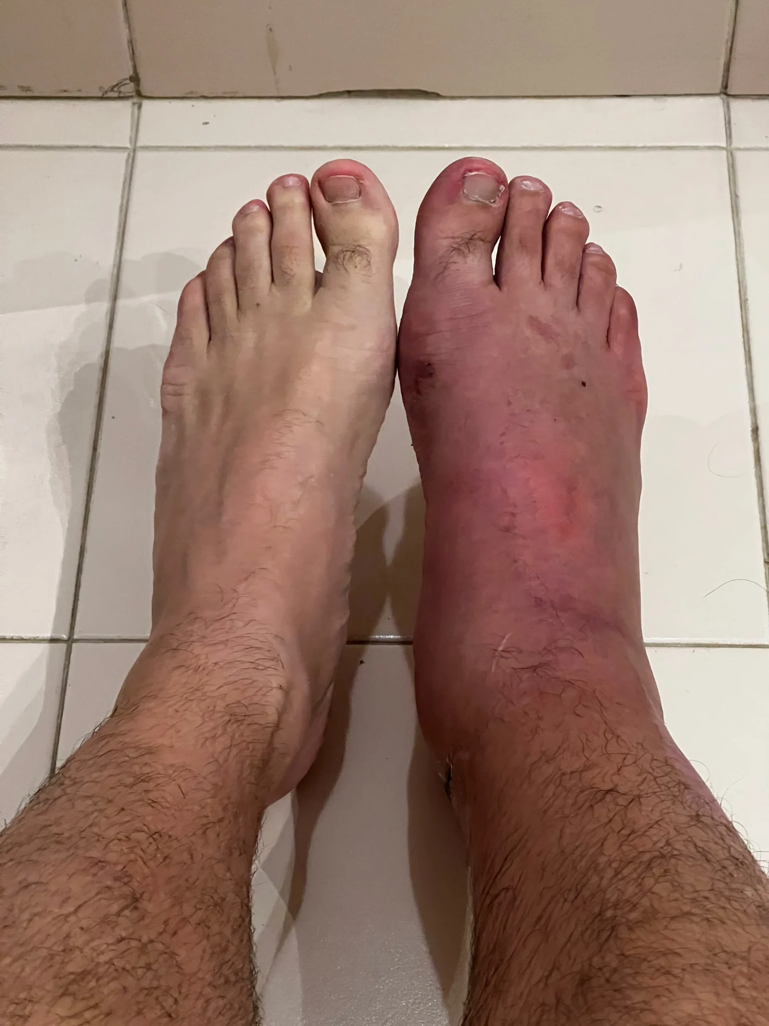 Pié hinchado luego de que me sacaran el yeso